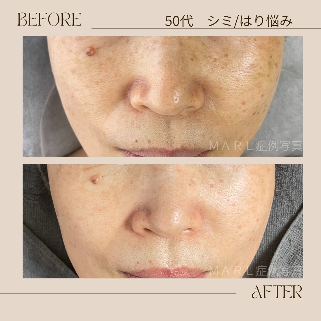 ハイドレートレストアセラム