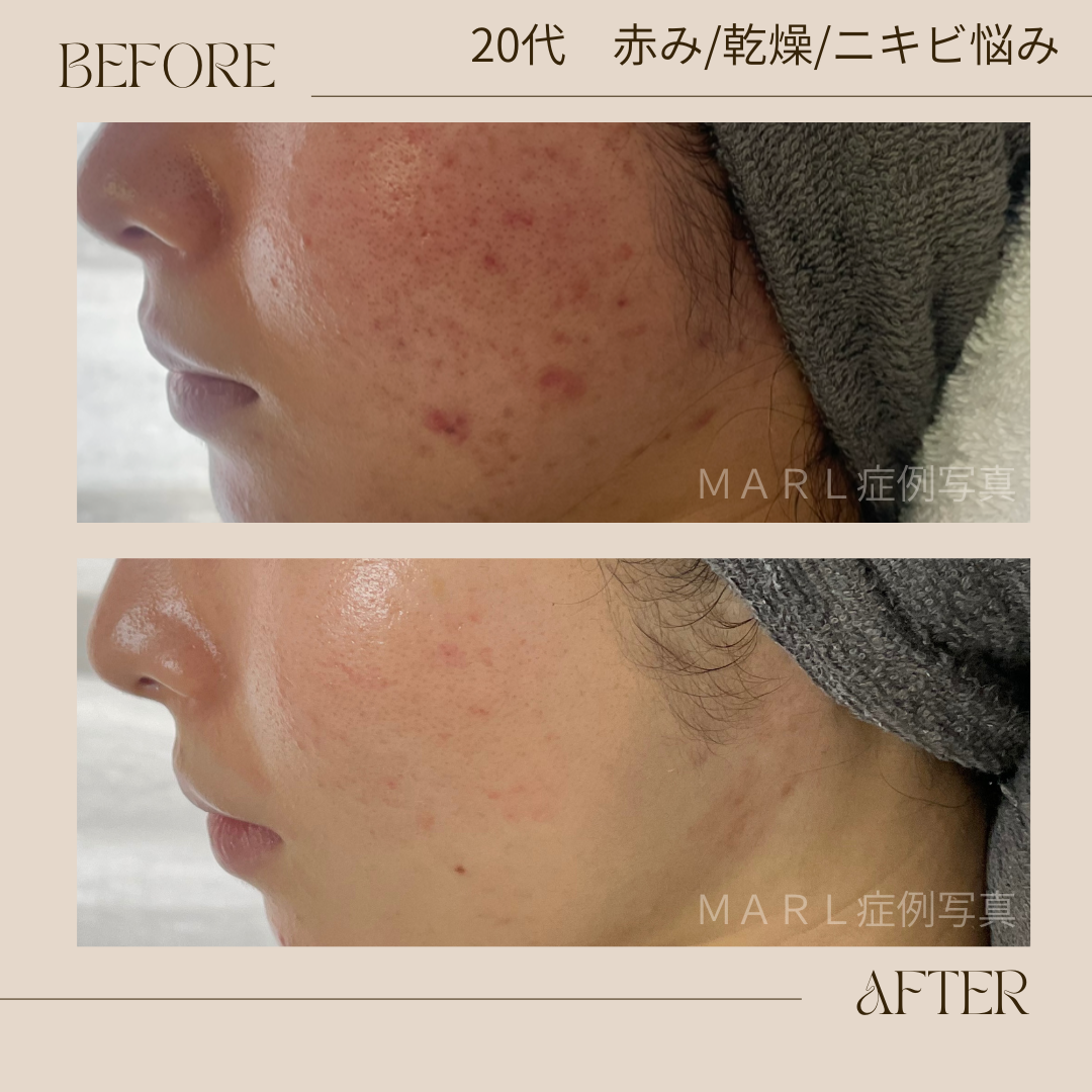 ハイドレートレストアセラム