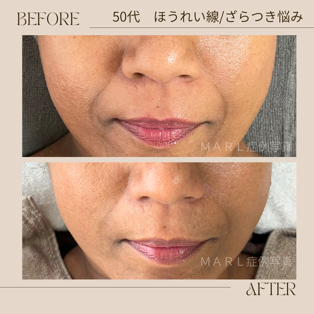 ハイドレートレストアセラム